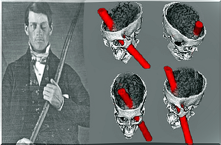 Phineas Gage and the Brain